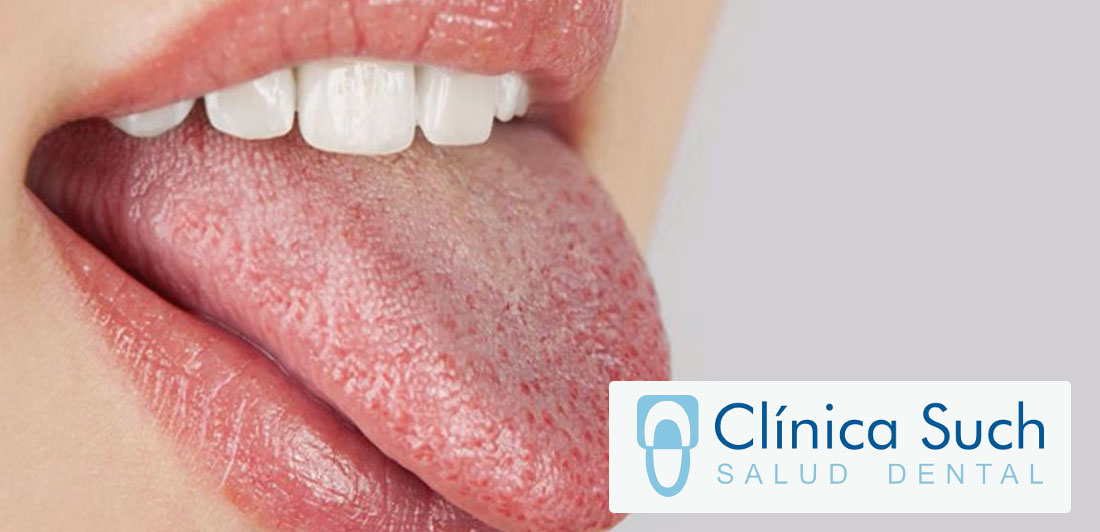 Cómo prevenir la sequedad bucal o Xerostomia