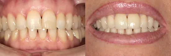 carillas clinica dental en valencia