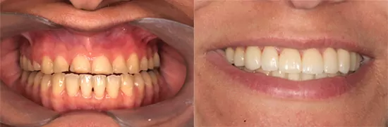 rhl carillas clinica dental en valencia