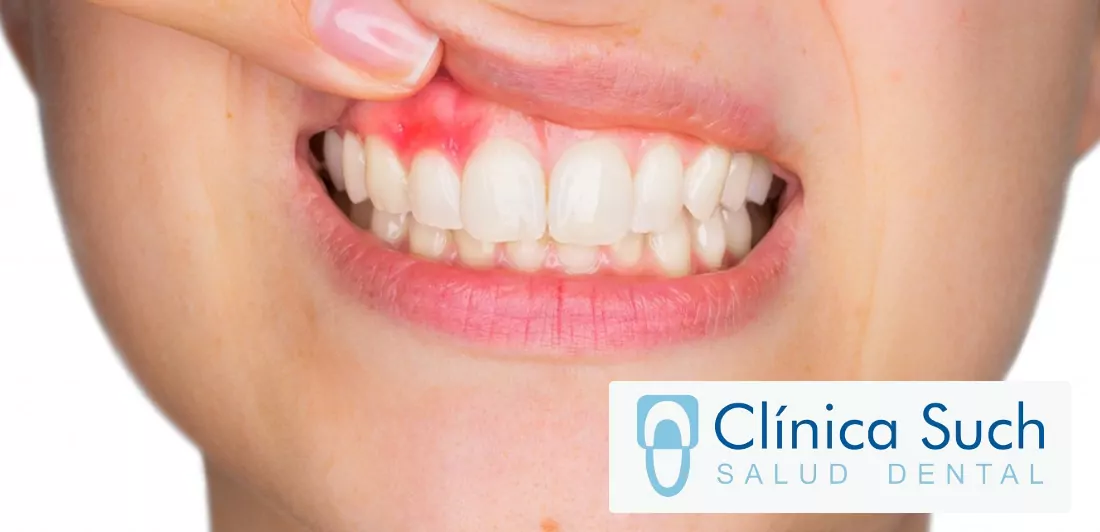 la-periodontitis-tratarla