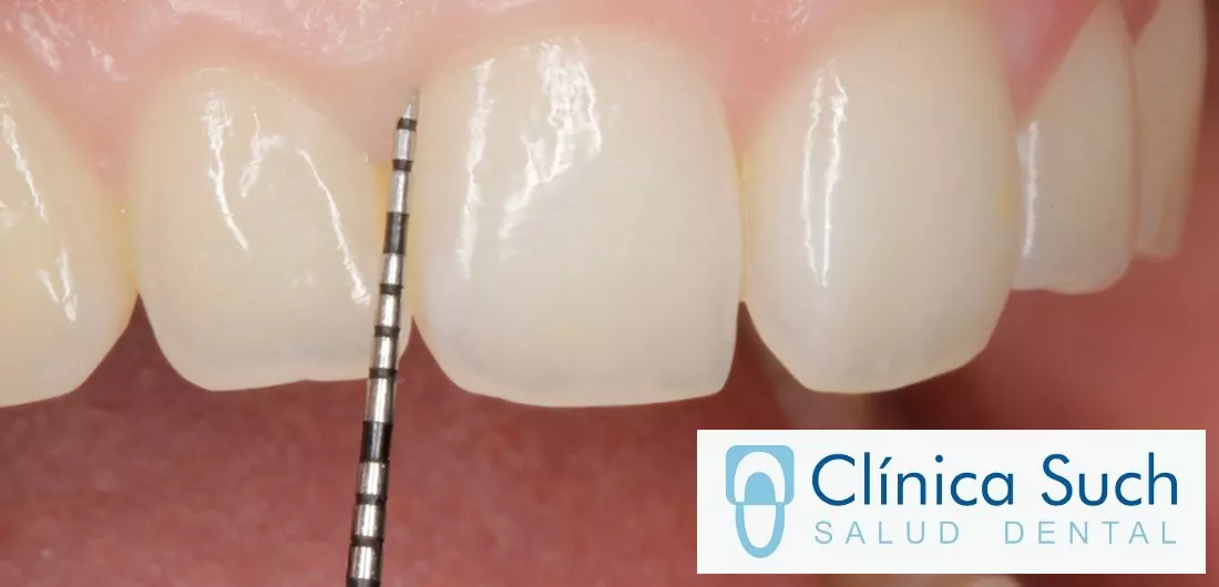 Tratamiento de periodoncia en Valencia