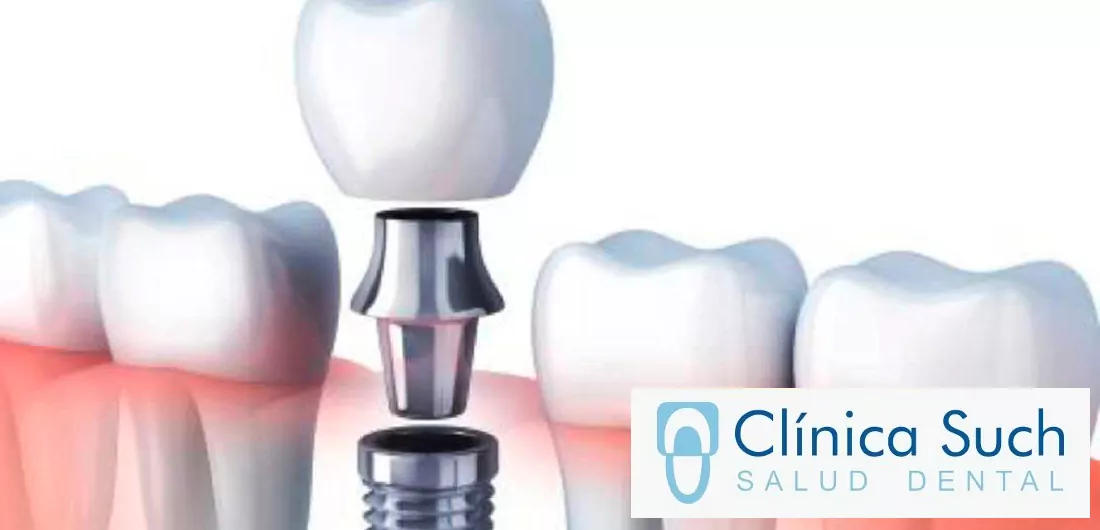 Implante o endodoncia que es mejor 2 clinica dental en valencia