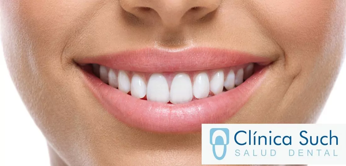 Cirugía de encías en Clínica Dental Such Valencia