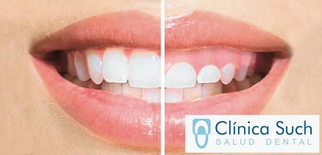 Tratamiento de encías y periodoncia en Valencia