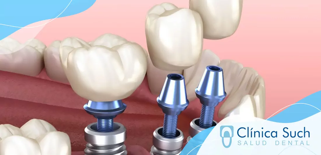 Implantes dentales en Valencia