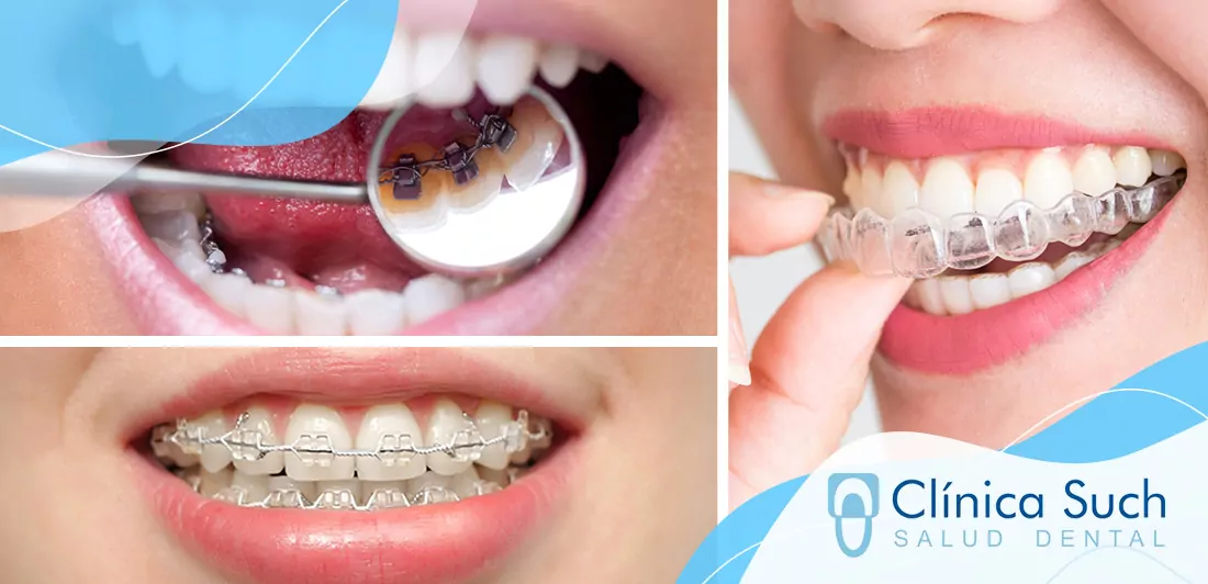 Orotodoncia invisible vs ortodoncia con brackets metálicos en Valencia
