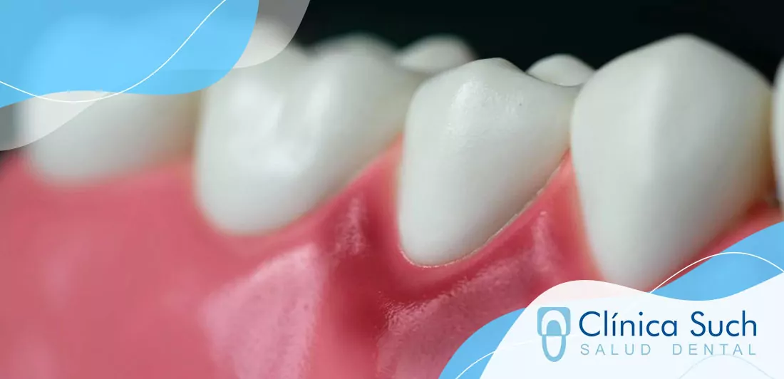 Blanqueamiento dental valencia