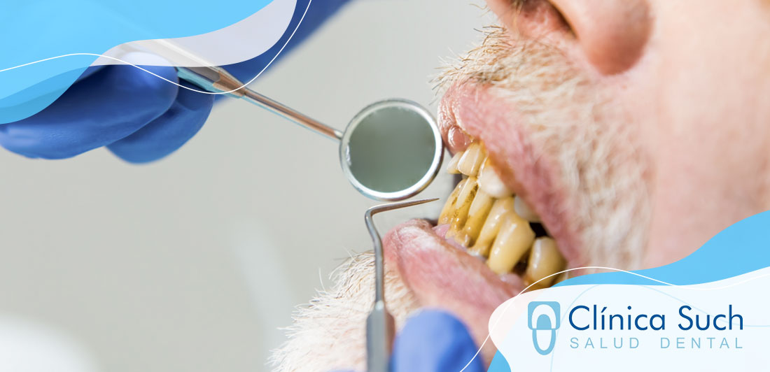 Consecuencias de una mala higiene bucal: encías inflamadas y sarro - Clínica Dental Such Valencia