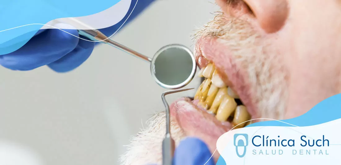 Endodoncia 70 Consecuencias de una mala higiene bucal: encías inflamadas y sarro - Clínica Dental Such Valencia