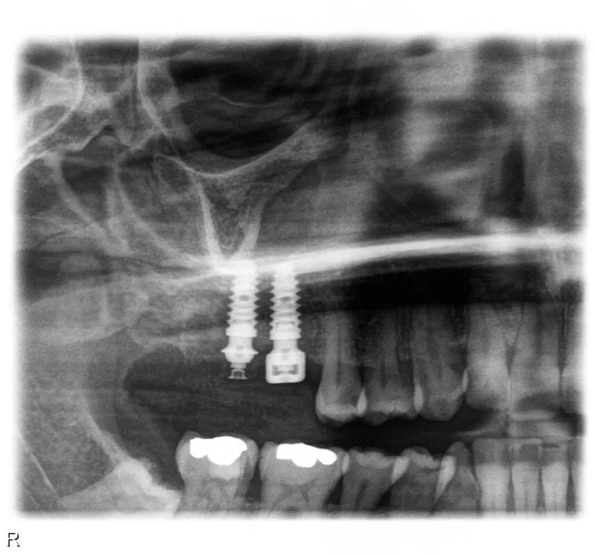 Radiografía dental 3d
