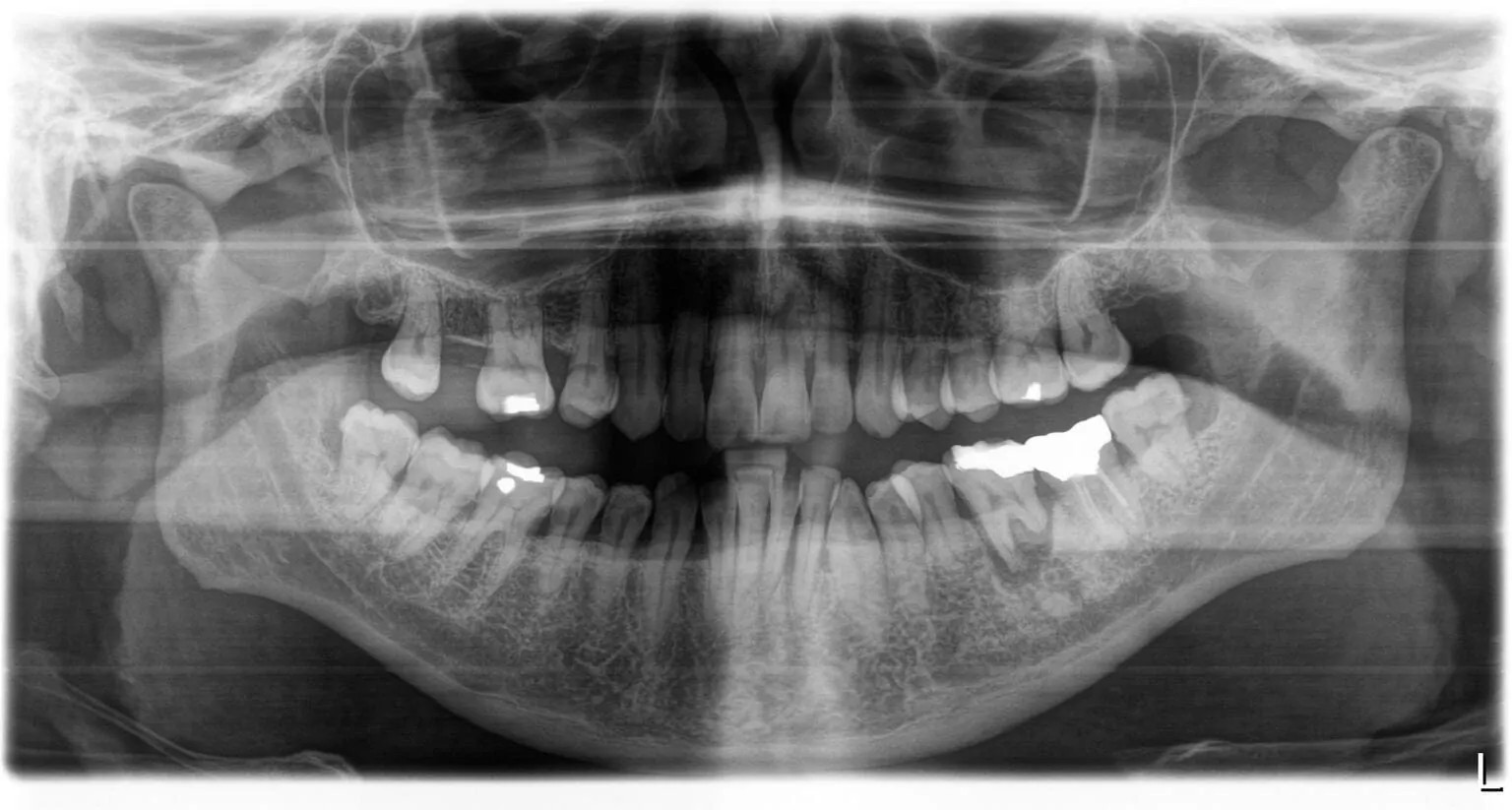 Implante dental radiografía