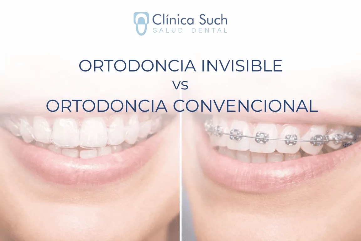 diferencias entre ortodoncia invisible invsilign y ortodoncia convencional con brackets metálticos