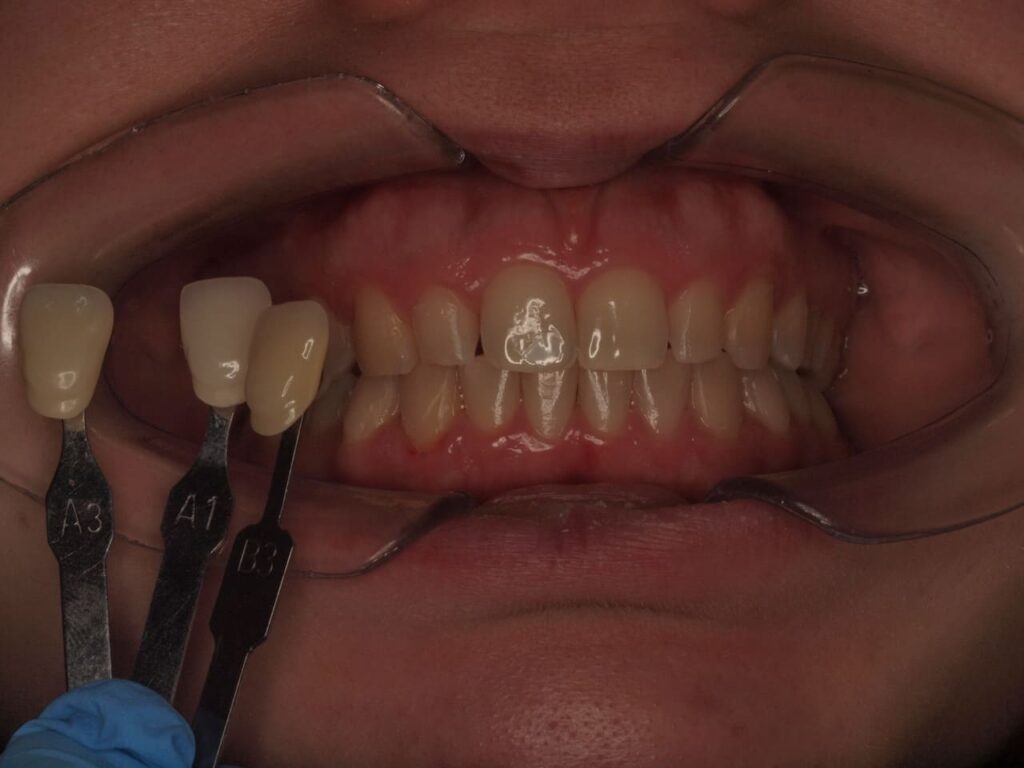 antes vs despues blanqueamiento dental en valencia