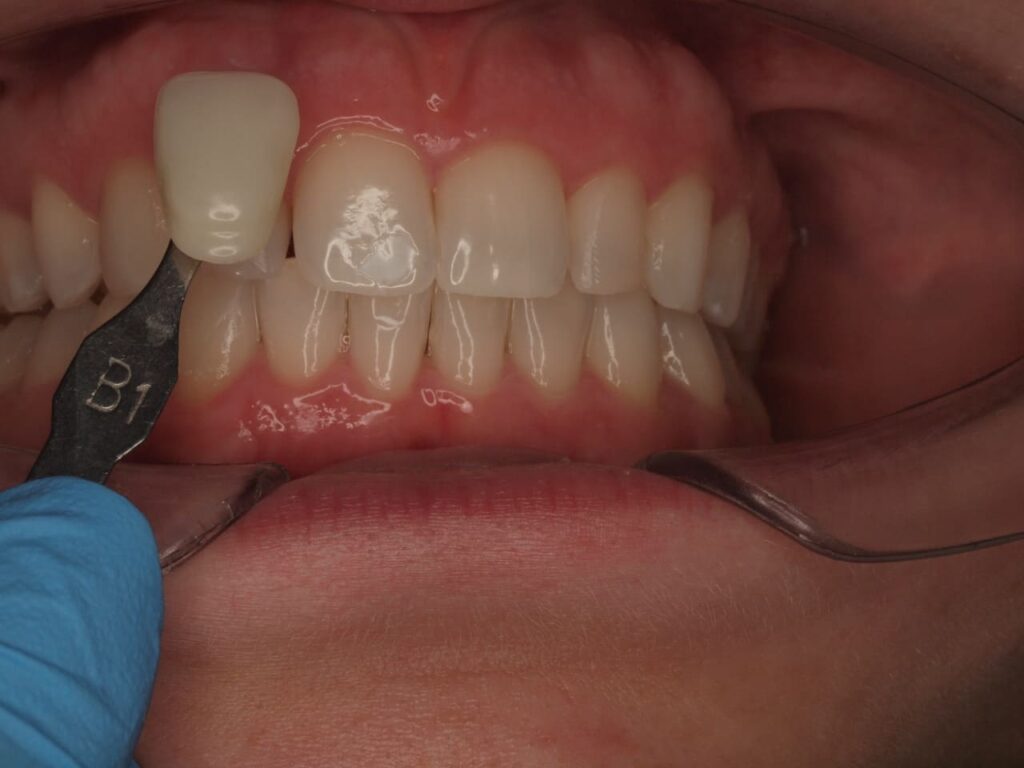 resultado después del tratamiento de blanqueamiento dental en valencia
