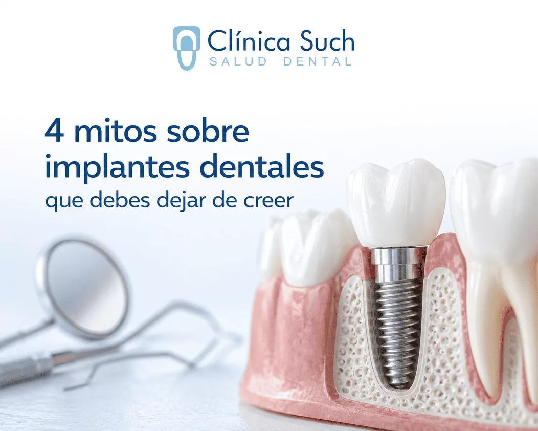 4 mitos sobre implantología dental guiada por el Doctor Joan Such Odontólogo en Valencia