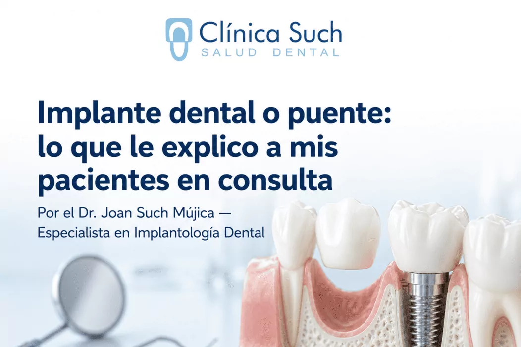 Comparativa entre un implante dental y un puente dental — Clínica Dental Such, Valencia