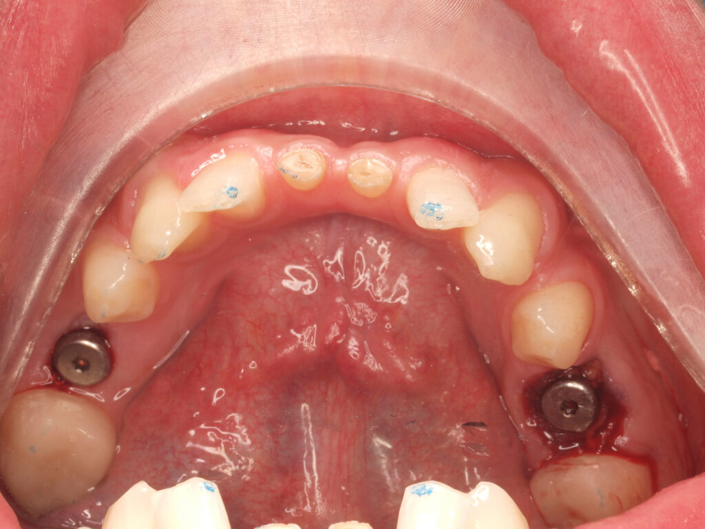 Arcada inferior al inicio: implantes en 35 y 45 por agenesia de los segundos premolares
