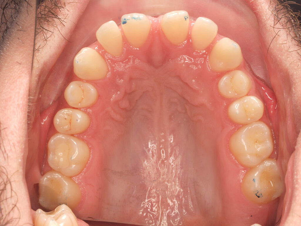 Arcada superior en vista oclusal al inicio del tratamiento
