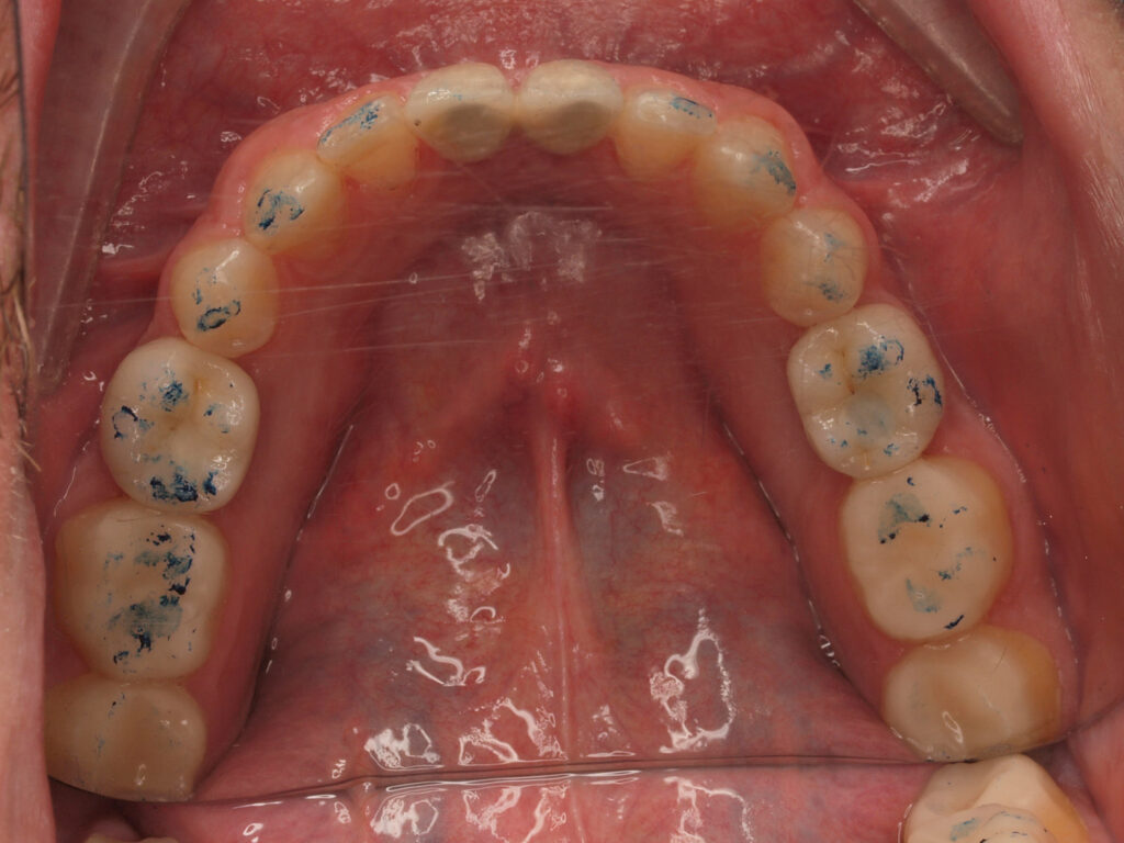 Arcada inferior al terminar: implantes en 31, 41, 35 y 45 e incrustaciones en molares y primeros premolares