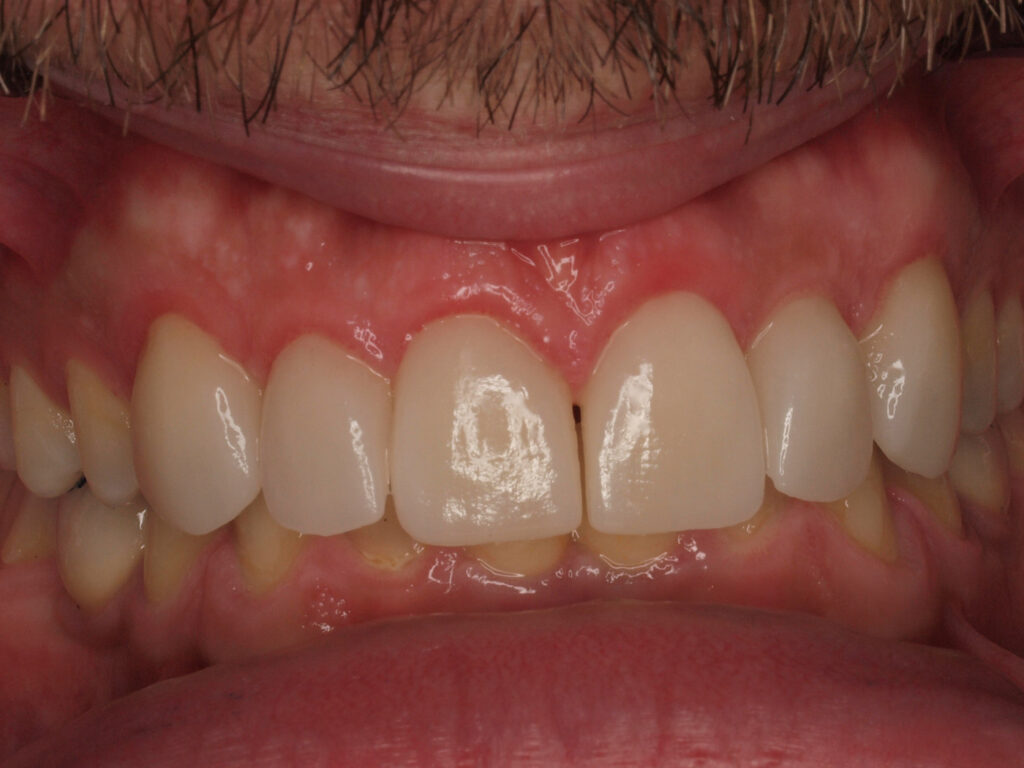 Agenesia dental resuelta con implantes, Invisalign y carillas: el caso de Borja