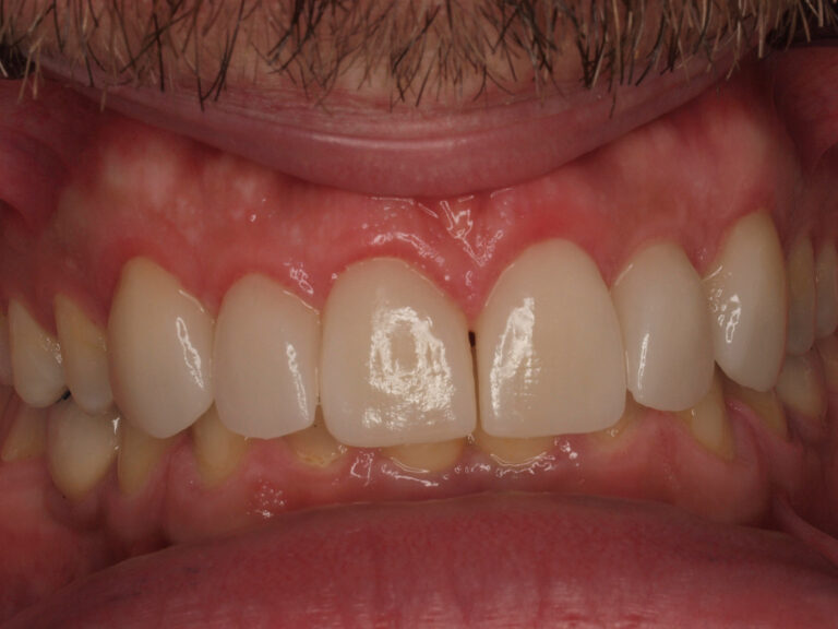 Agenesia dental resuelta con implantes, Invisalign y carillas: el caso de Borja 1 Resultado final en vista frontal tras ortodoncia invisible, implantes por agenesia y carillas 3+3 superiores