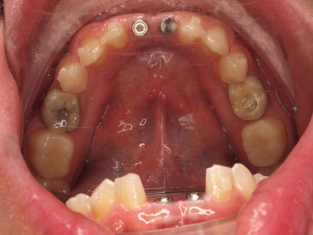 Implantes en 31 y 41 por agenesia de los incisivos centrales inferiores, antes de las coronas