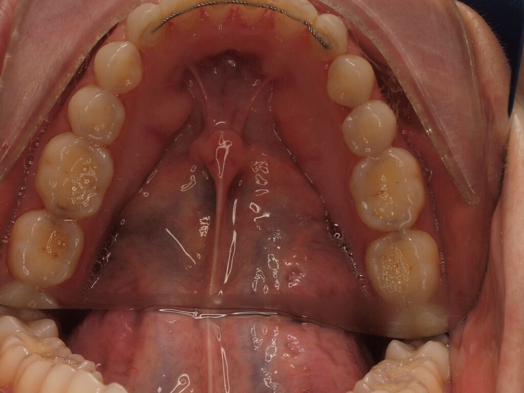 Antes del tratamiento: vista oclusal de la arcada inferior con las superficies de masticación desgastadas, caso de reconstrucciones oclusales del Dr. Joan Such en Valencia