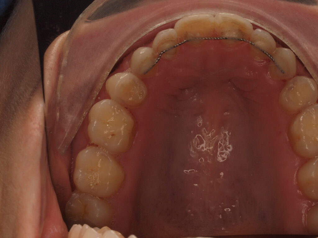 Antes del tratamiento: vista oclusal de la arcada superior de Ana, con desgaste en los dientes anteriores y en las superficies de masticación. Caso de carillas vestibulares y palatinas del Dr. Joan Such en Clínica Dental Such, Valencia
