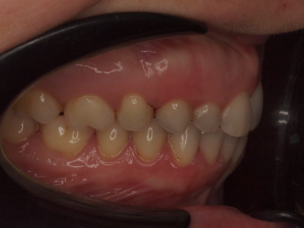 Antes del tratamiento: vista lateral derecha con los dientes desgastados y la mordida perdiendo altura, caso de rehabilitación adhesiva en Clínica Dental Such, Valencia