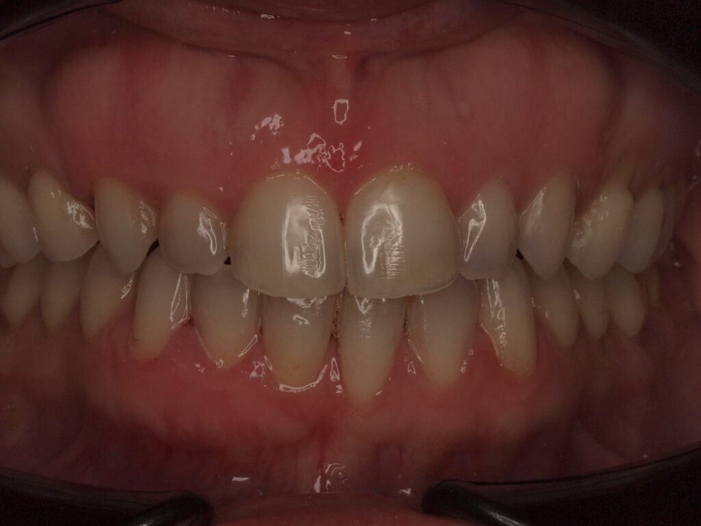 Antes del tratamiento: vista frontal en oclusión con los dientes de delante acortados por el desgaste y la mordida cerrada de más, Clínica Dental Such, Valencia