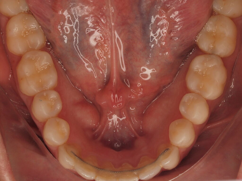 Después del tratamiento: vista oclusal de la arcada inferior con las superficies de masticación reconstruidas para devolver la altura de la mordida, Dr. Joan Such, Valencia