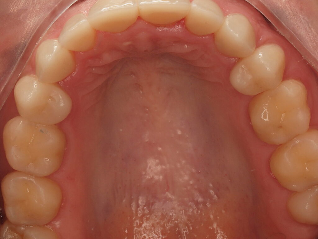 Después del tratamiento: vista oclusal de la arcada superior con carillas vestibulares y palatinas de premolar a premolar y superficies oclusales reconstruidas, Clínica Dental Such, Valencia