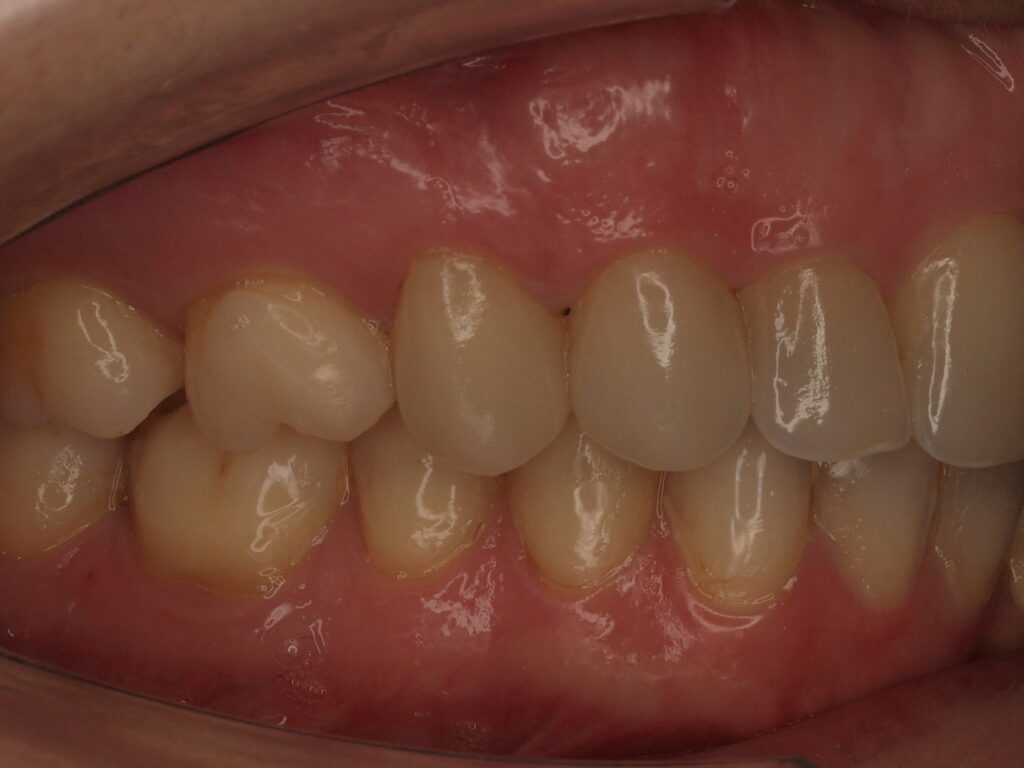 Después del tratamiento: vista lateral derecha con las reconstrucciones oclusales que devuelven la dimensión vertical y reparten la masticación, Dr. Joan Such, Valencia