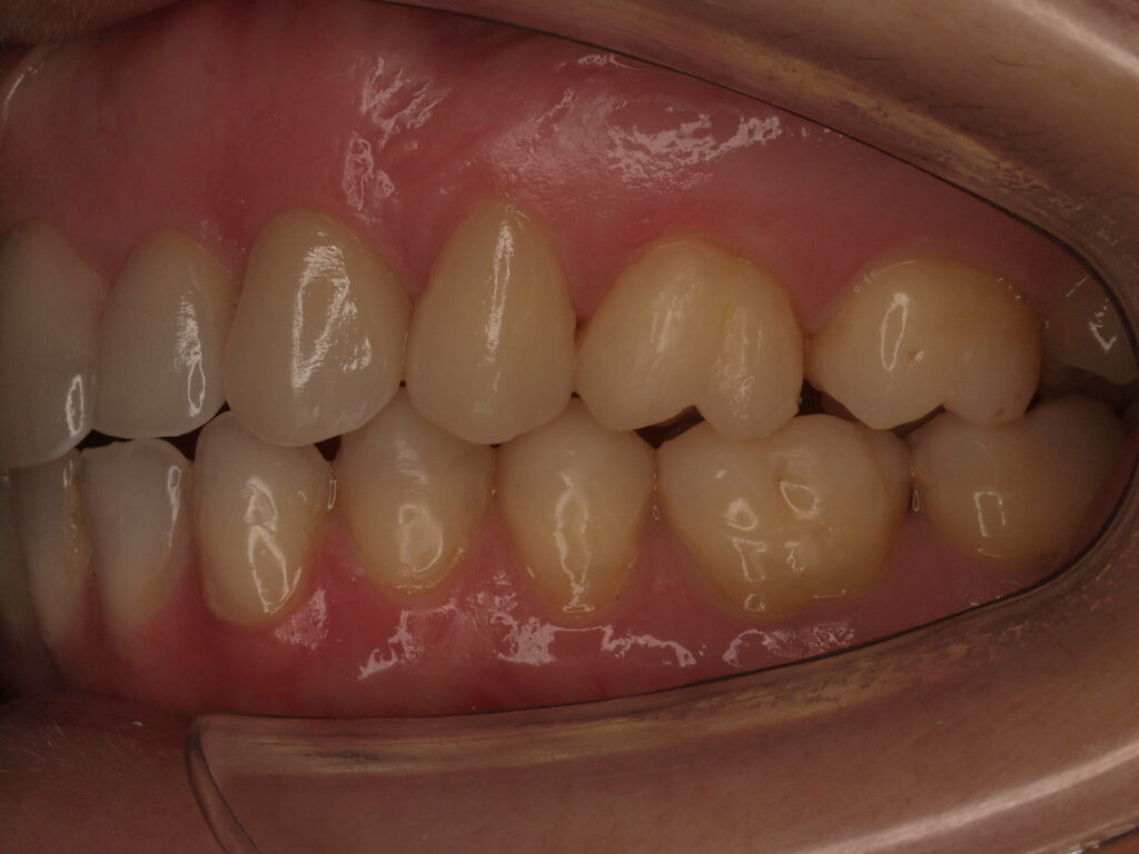 Después del tratamiento: vista lateral izquierda con las reconstrucciones oclusales y los contactos recuperados, Clínica Dental Such, Valencia