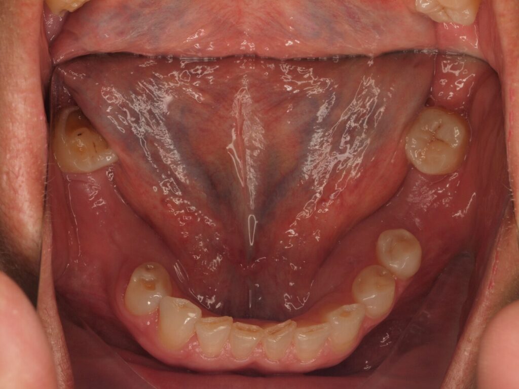 Antes del tratamiento: arcada inferior de Ángeles Beleña con ausencia de varios molares y premolares, caso de implantes dentales del Dr. Joan Such en Valencia