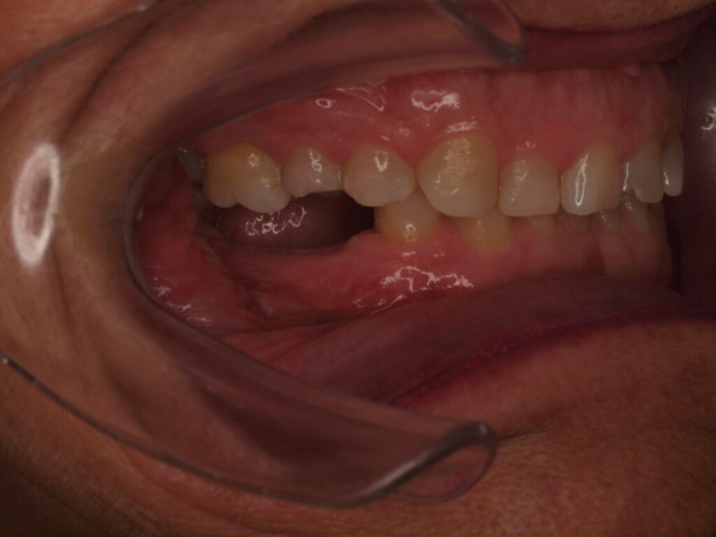 Implantes dentales para volver a masticar: el caso de Ángeles Beleña 5 Antes del tratamiento: espacio sin molares en el sector posterior derecho, caso de implantes dentales en Valencia