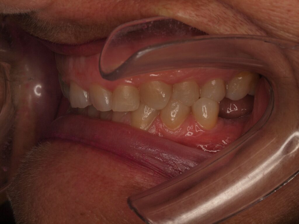 Implantes dentales para volver a masticar: el caso de Ángeles Beleña 7 Antes del tratamiento: ausencia de molares inferiores en el lado izquierdo, caso de implantes dentales en Valencia