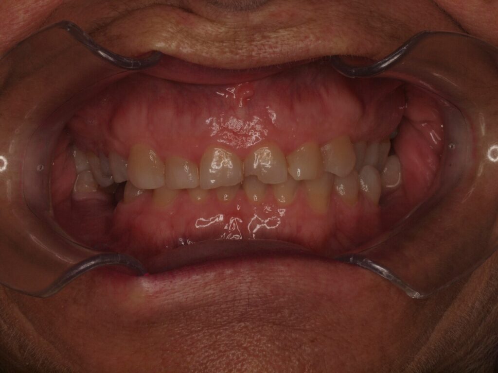 Implantes dentales para volver a masticar: el caso de Ángeles Beleña 3 Antes del tratamiento de implantes dentales: vista frontal de la mordida de la paciente en Clínica Dental Such, Valencia