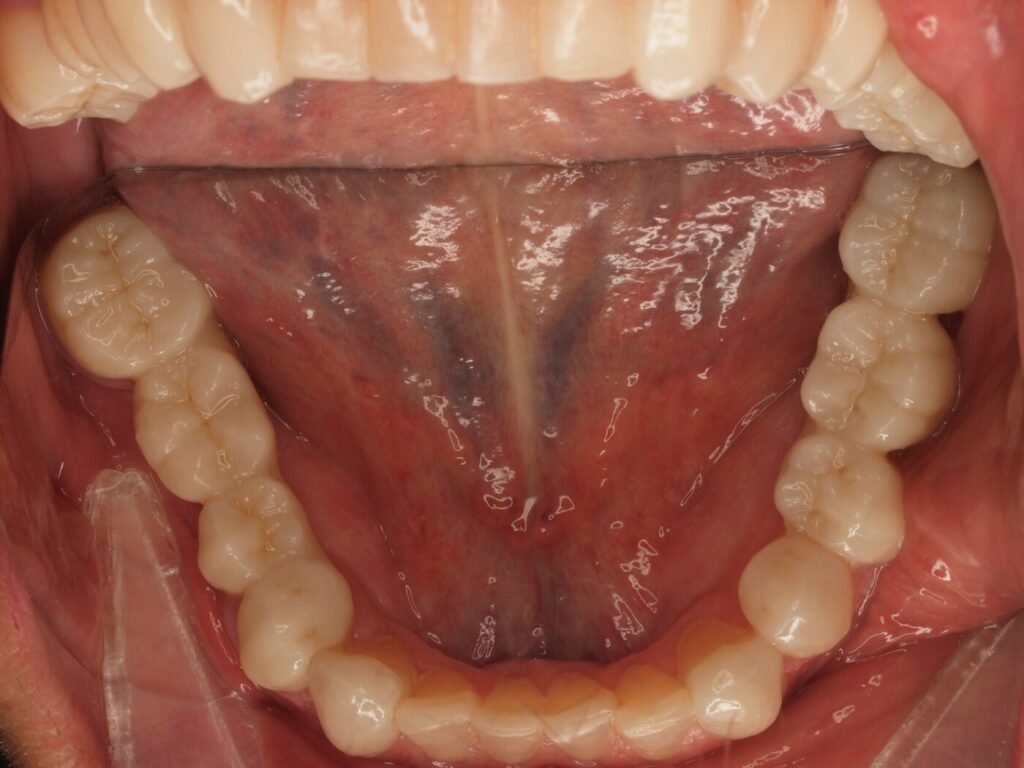 Después del tratamiento: arcada inferior completa con coronas sobre implantes dentales colocados por el Dr. Joan Such en Valencia
