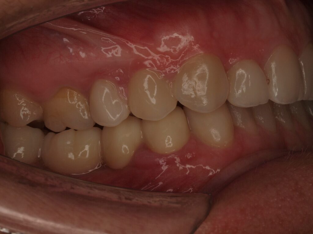 Implantes dentales para volver a masticar: el caso de Ángeles Beleña 6 Después del tratamiento: sector posterior derecho con coronas sobre implantes dentales en Clínica Dental Such, Valencia