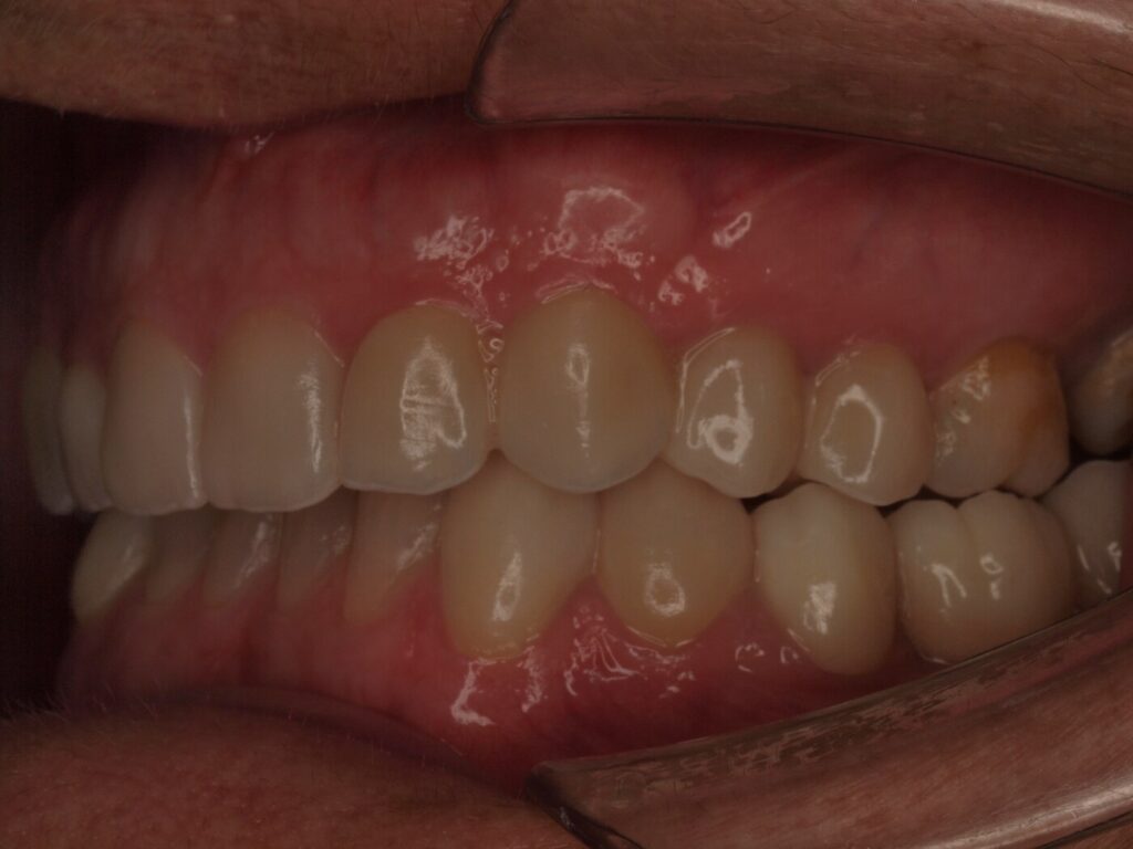 Implantes dentales para volver a masticar: el caso de Ángeles Beleña 8 Después del tratamiento: sector posterior izquierdo rehabilitado con coronas sobre implantes dentales en Valencia