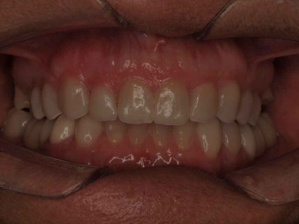 Implantes dentales para volver a masticar: el caso de Ángeles Beleña 4 Después del tratamiento de implantes dentales: vista frontal con la mordida rehabilitada en Clínica Dental Such, Valencia