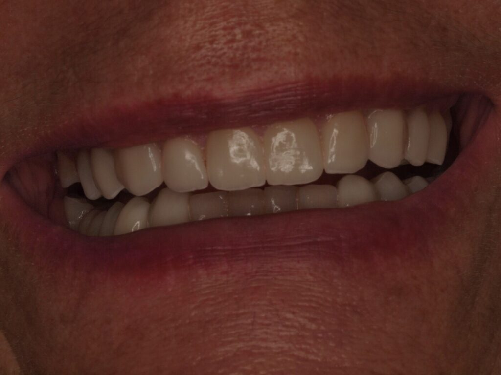Sonrisa final de Ángeles Beleña tras el tratamiento de implantes dentales realizado por el Dr. Joan Such en Clínica Dental Such, Valencia