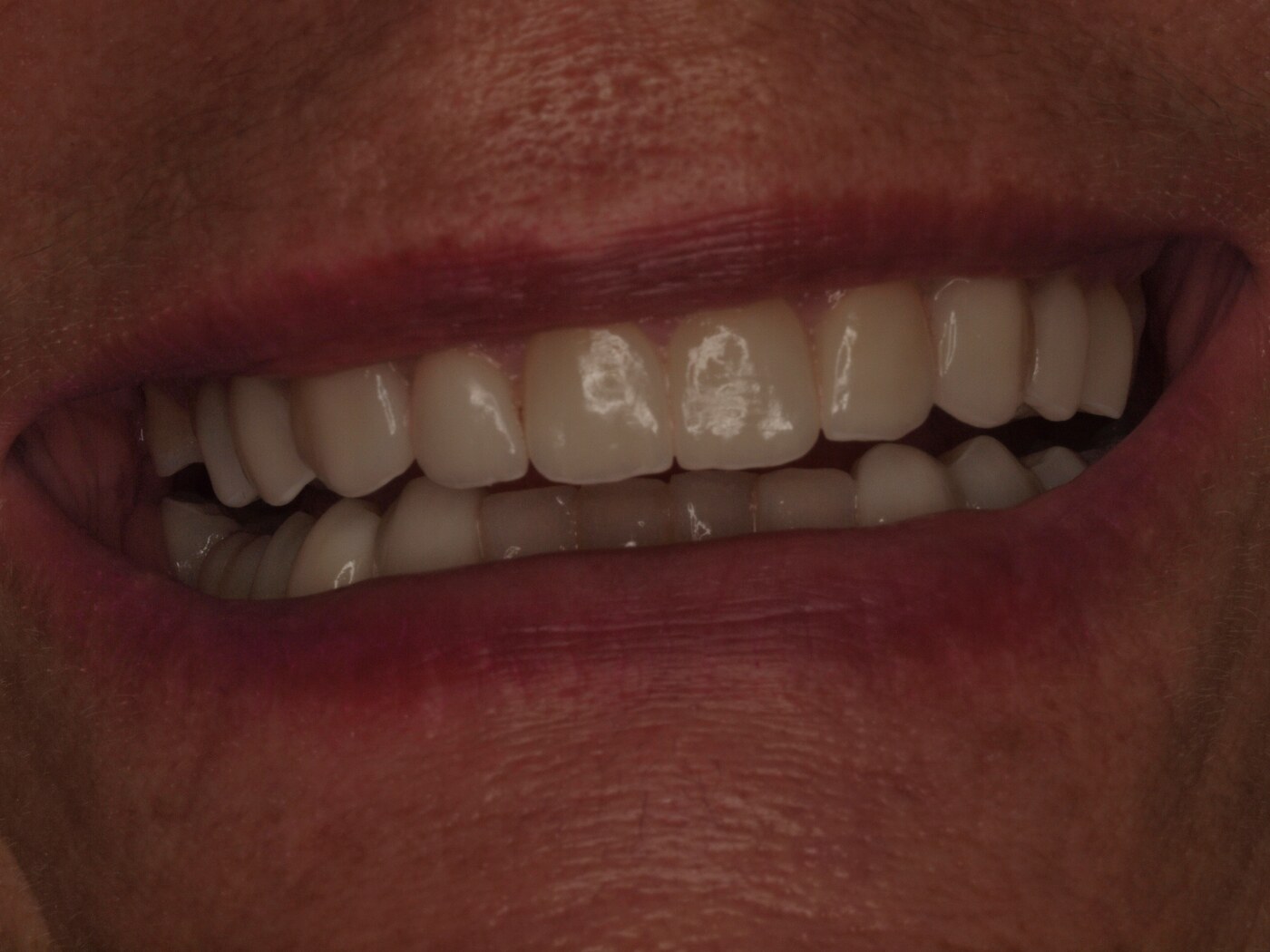 Sonrisa final de Ángeles Beleña tras el tratamiento de implantes dentales realizado por el Dr. Joan Such en Clínica Dental Such, Valencia