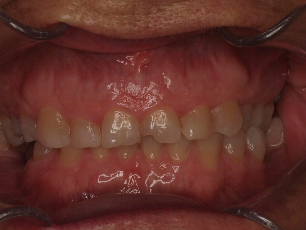 Rehabilitación adhesiva con carillas y circonio: el caso de Ángeles 3 Antes del tratamiento: vista frontal con los dientes de delante acortados por el desgaste, Clínica Dental Such, Valencia