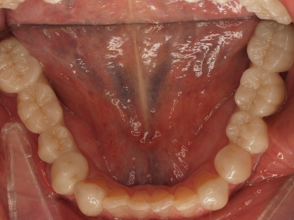 Después del tratamiento: arcada inferior completa con coronas de circonio de 33 a 37 y de 43 a 47, Clínica Dental Such en Valencia