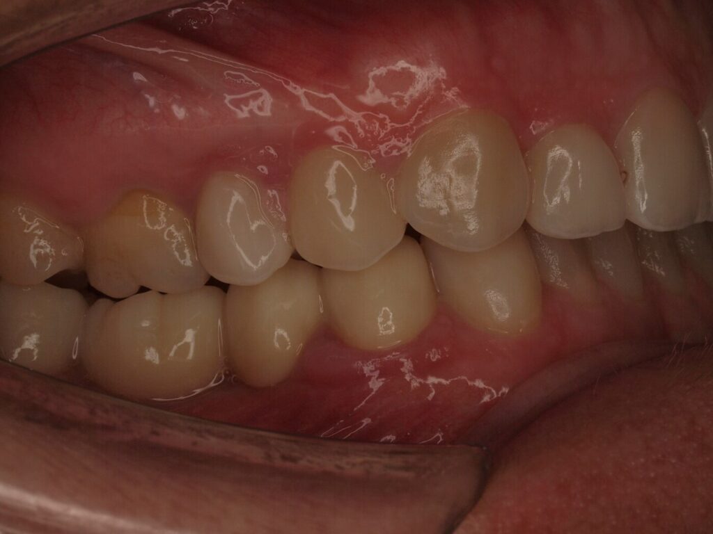 Rehabilitación adhesiva con carillas y circonio: el caso de Ángeles 6 Después del tratamiento: sector posterior derecho con coronas de circonio y contactos recuperados, Clínica Dental Such, Valencia
