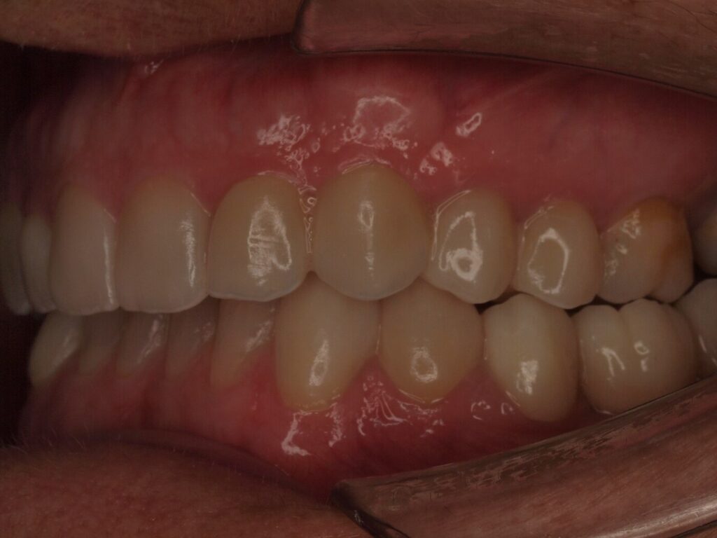 Rehabilitación adhesiva con carillas y circonio: el caso de Ángeles 8 Después del tratamiento: sector posterior izquierdo rehabilitado con coronas de circonio, Clínica Dental Such, Valencia