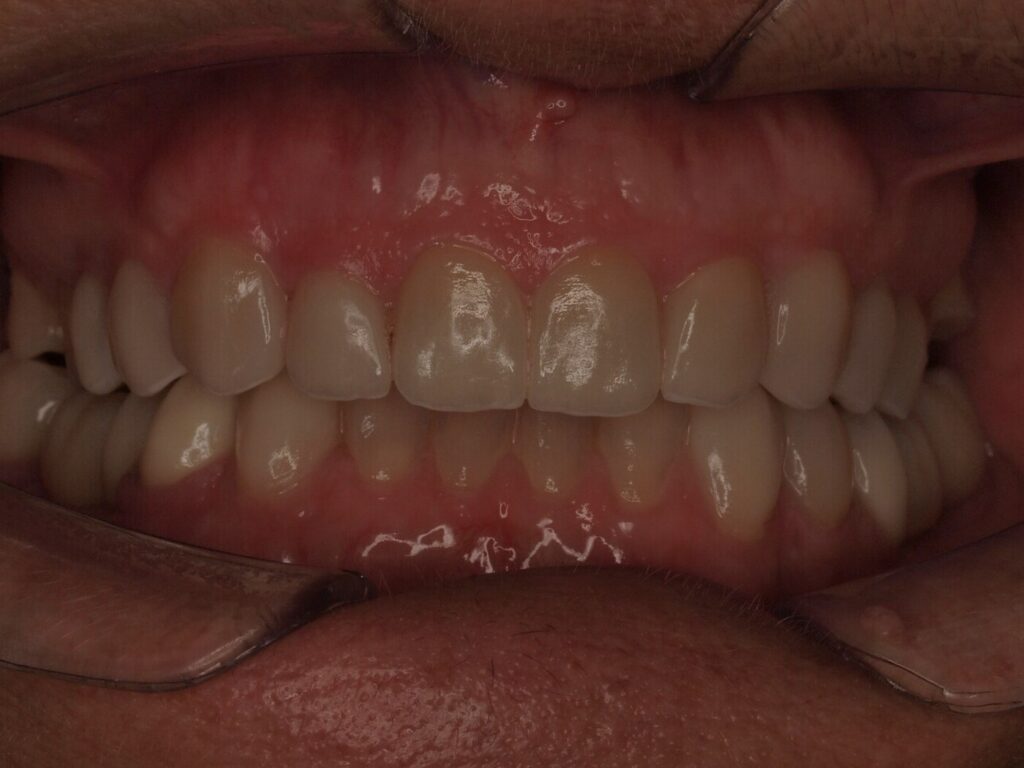 Rehabilitación adhesiva con carillas y circonio: el caso de Ángeles 4 Después del tratamiento: vista frontal con carillas de canino a canino arriba y bordes incisales reconstruidos abajo, Clínica Dental Such, Valencia