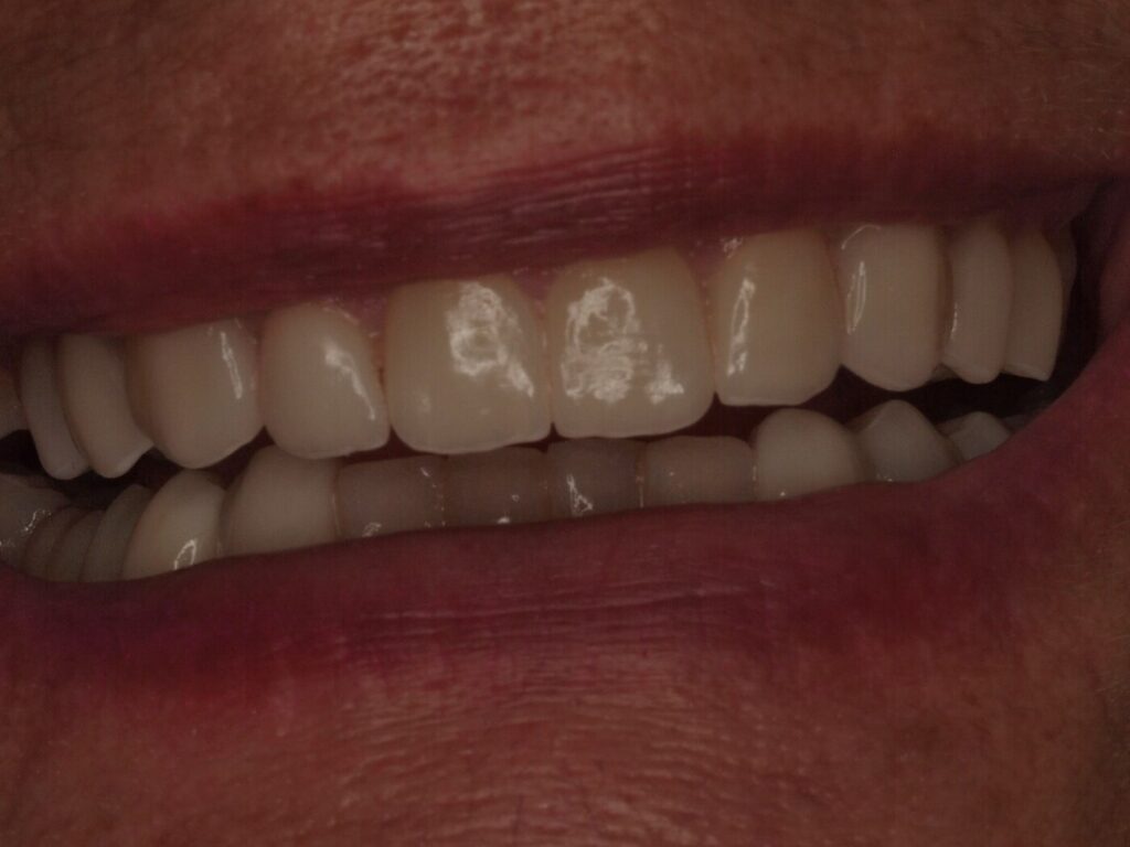 Sonrisa final de Ángeles tras la rehabilitación adhesiva con carillas y coronas de circonio realizada por el Dr. Joan Such en Clínica Dental Such, Valencia
